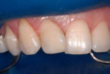 Restaurar a harmonia em dentes desalinhados